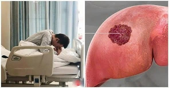 Bệnh nhân qua đời sau 60 ngày phát hiện UT g:a:n, BS khẩn cầu: Đừng ăn 2 món h:ủ:y d:iệ:t g:a:n nữa